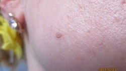 Removing warts at home