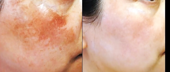 An incredibly simple way to remove pigment spots on the skin